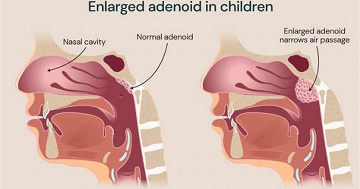 Do Adenoids Go Away?