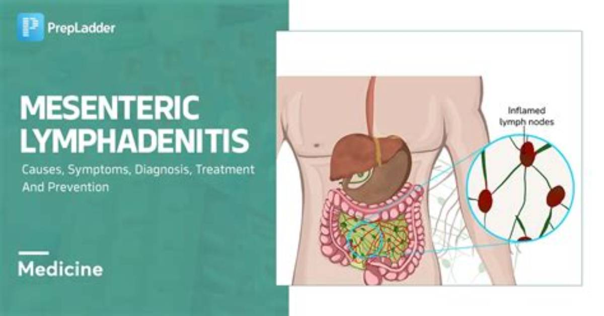 Do Adults Get Mesenteric Adenitis?
