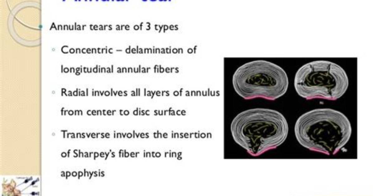Do All Annular Tears Heal?
