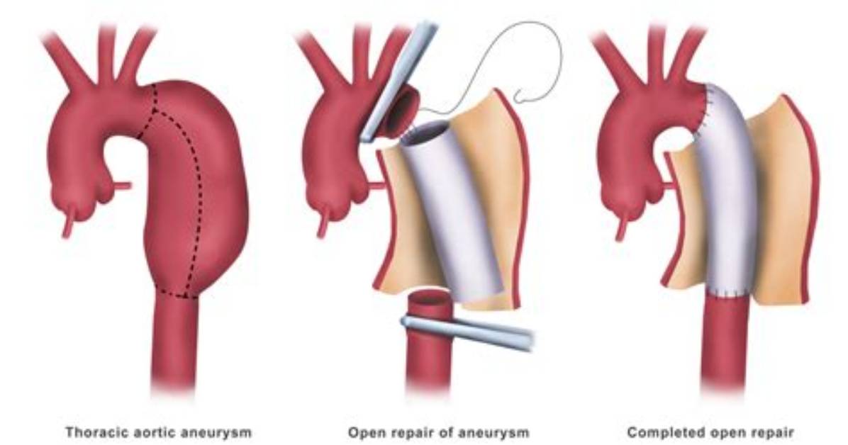 Do All Aortic Aneurysms Need Surgery?