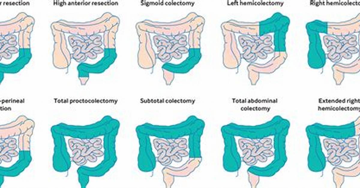 Do All Bowel Resections Require a Stoma?