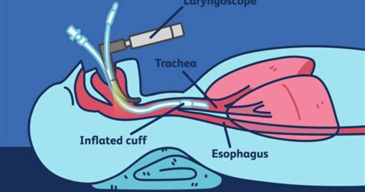 Do All Surgeries Require Intubation?