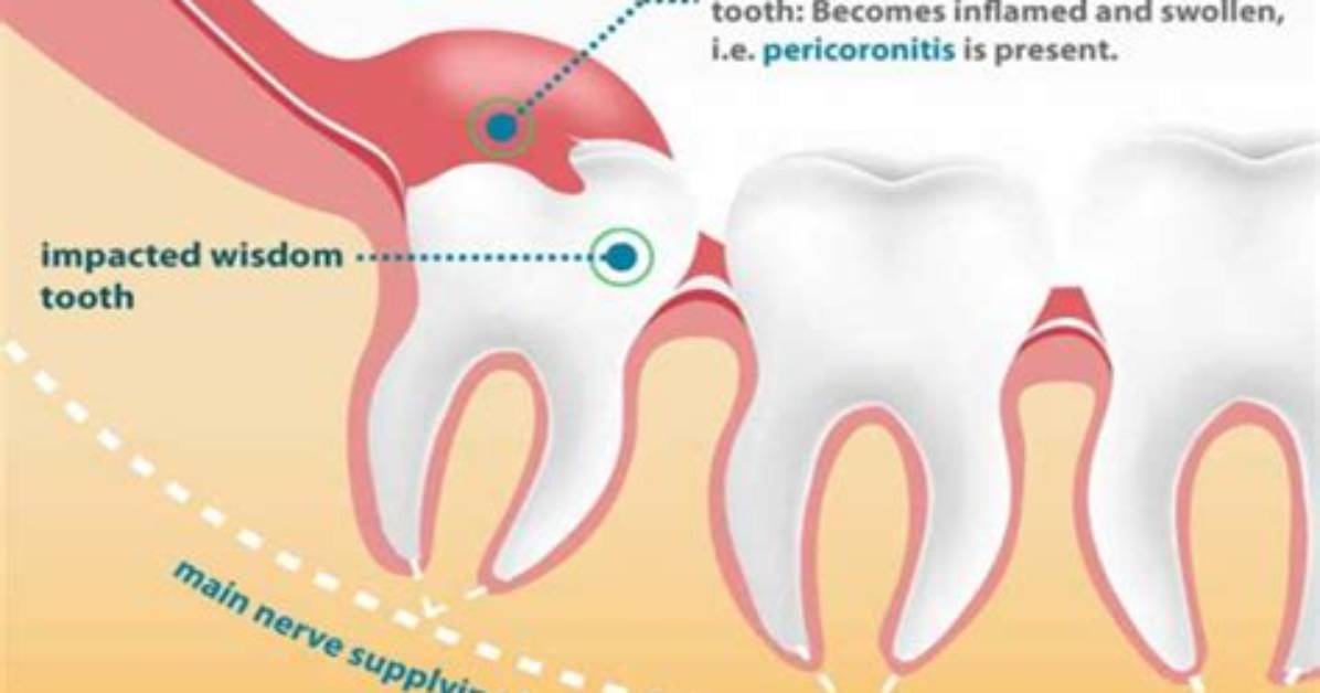 Do All Wisdom Teeth Come out?