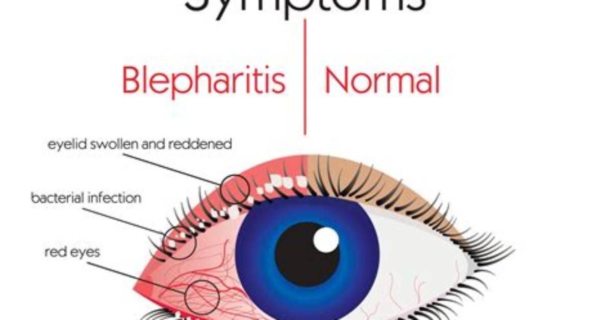 Do Allergies Cause Blepharitis?