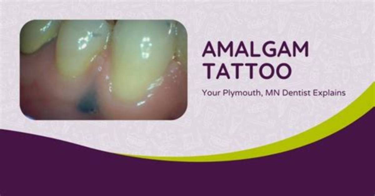 Do Amalgam Tattoos Go Away