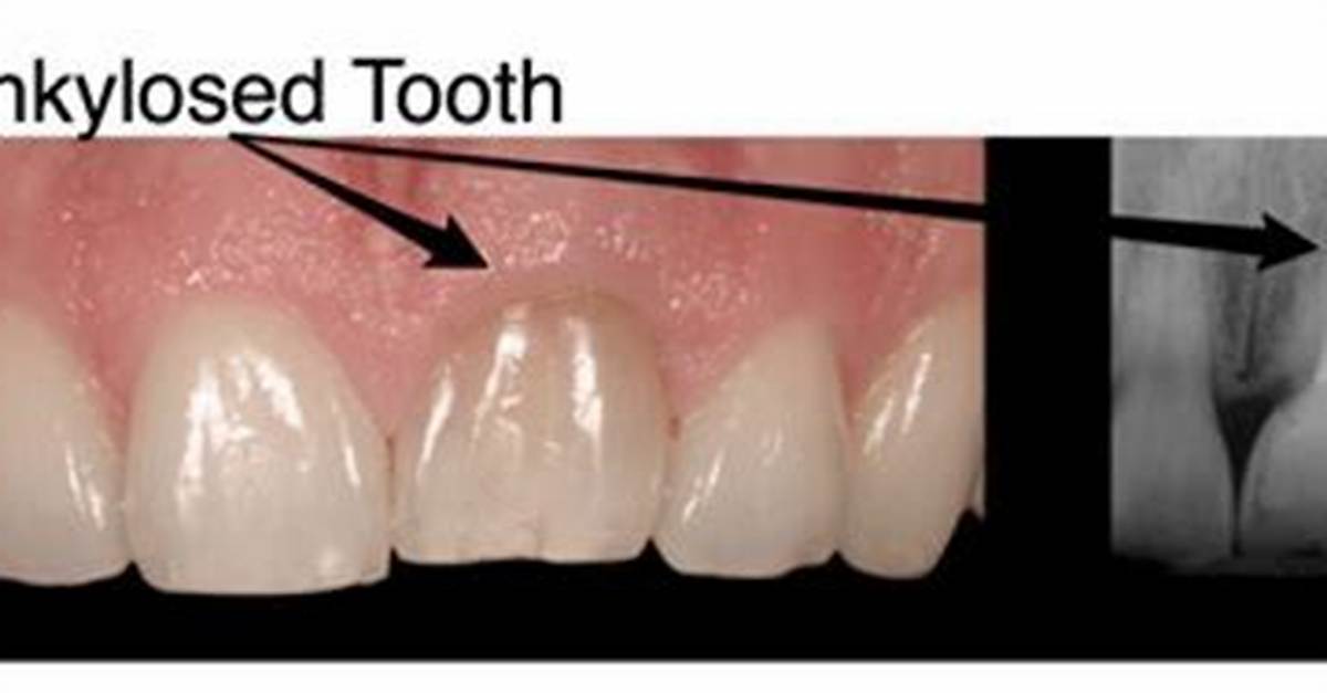 Do Ankylosed Teeth Need to Be Removed?