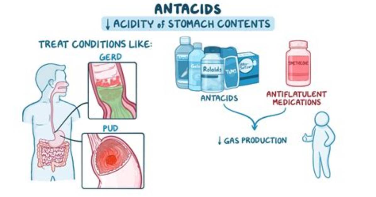 Do Antacids Help Ulcers?