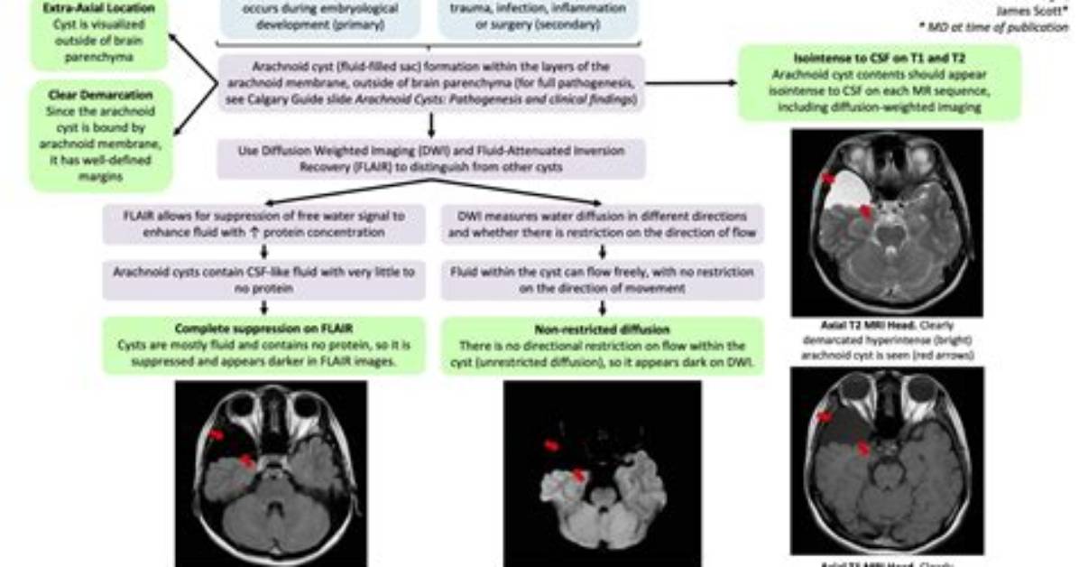 Do Arachnoid Cysts Recur?