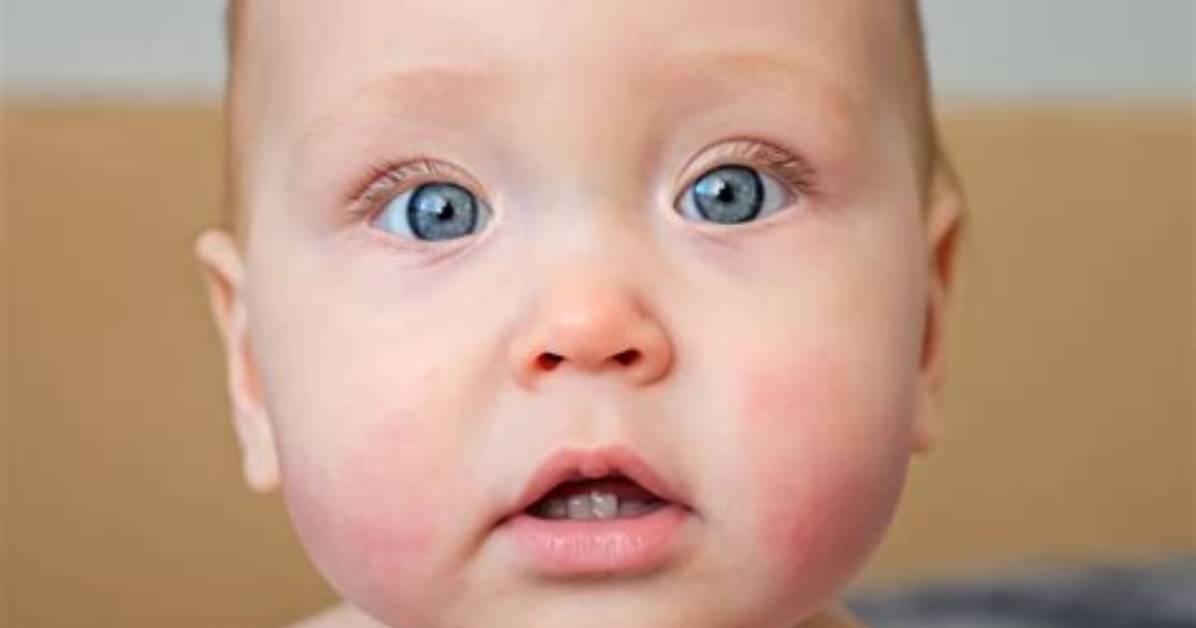 Do Babies Get Rosy Cheeks When Teething?
