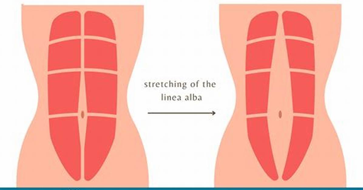 Do Babies Have Diastasis Recti?