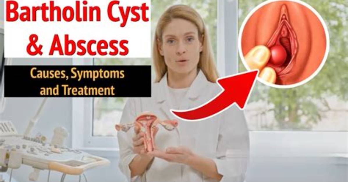 Do Bartholin Cysts Recur?