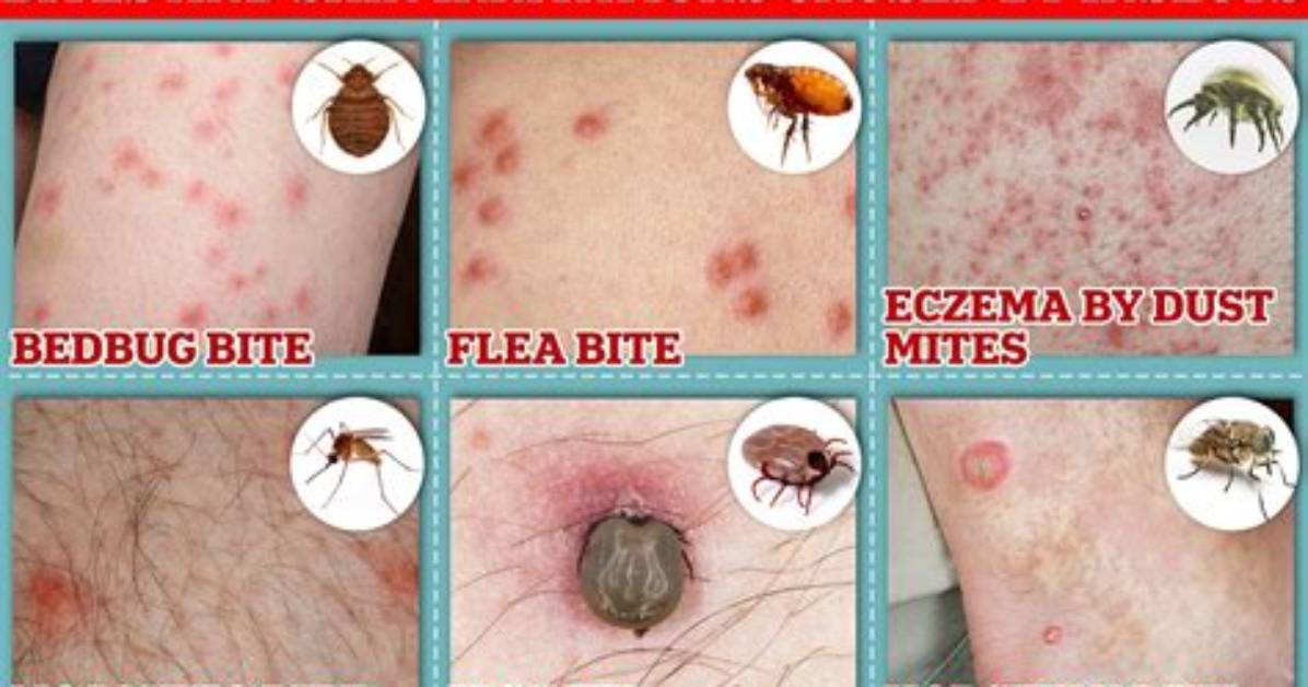 Do Bed Bugs Bite?