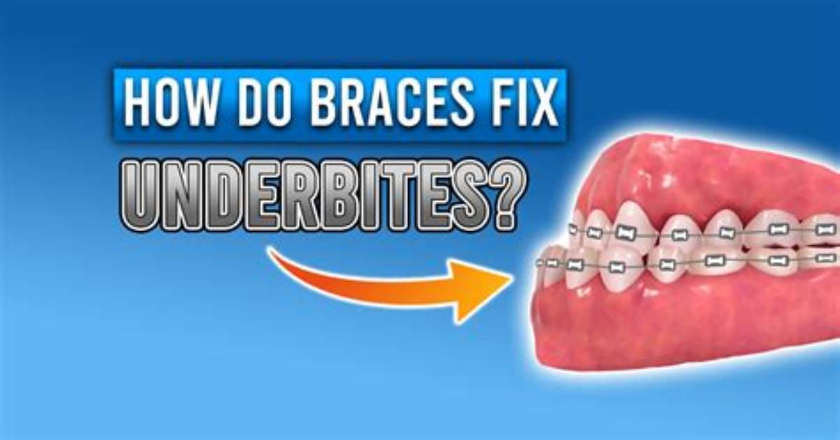 Do Braces Fix Underbite?