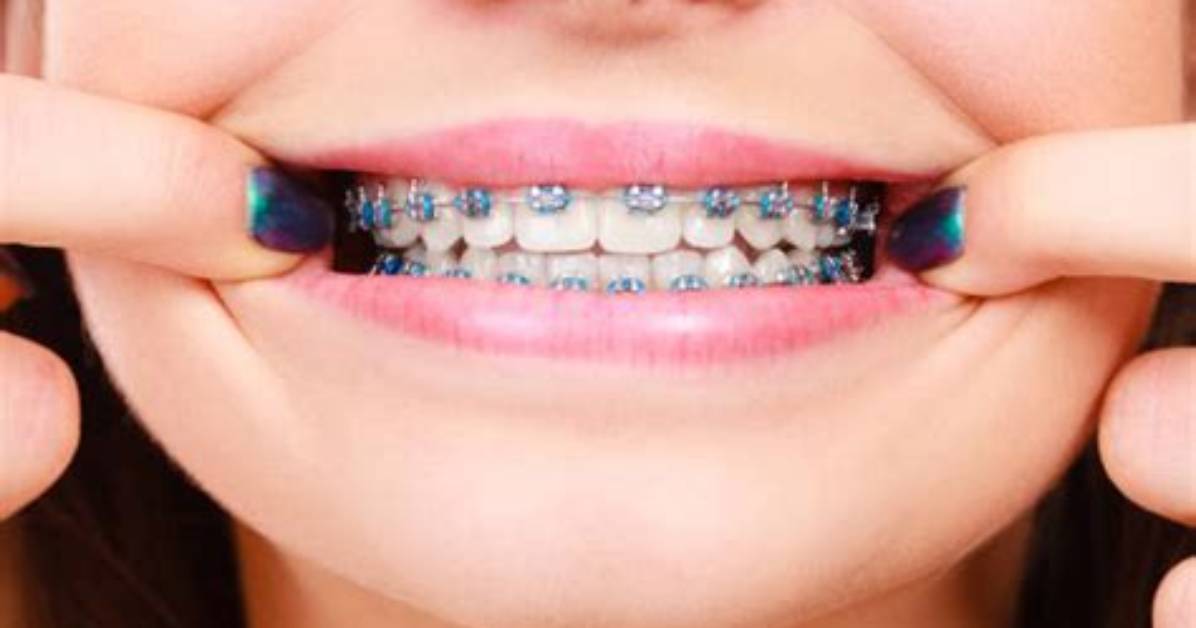 Do Braces Hurt When You Get Them off?