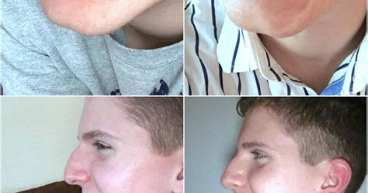 Do Braces Move Your Jaw?
