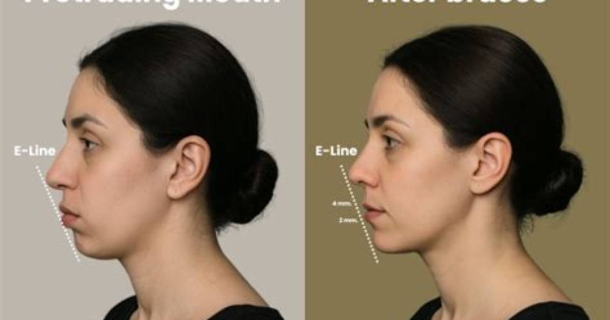 Do Braces Push Your Lips out?