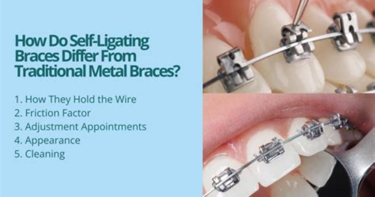 Do Braces Self Tighten?