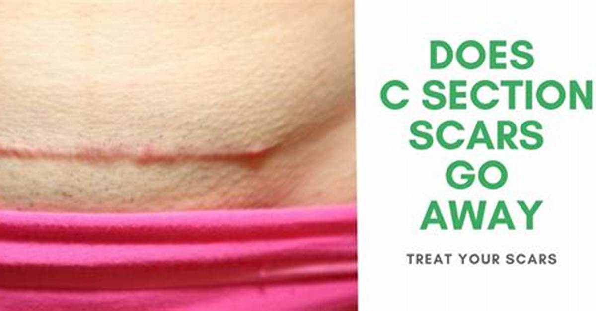 Do C Section Scars Go Away?