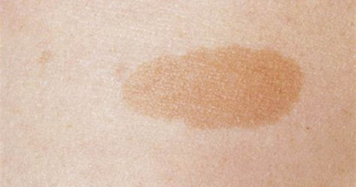 Do Cafe Au Lait Spots Get Darker?