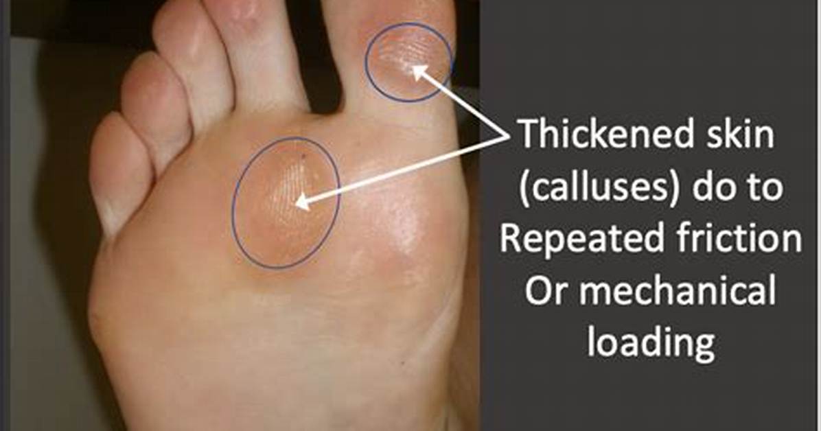 Do Calluses Grow Back?