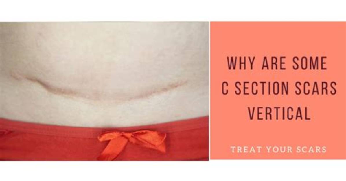 Do Cesarean Scars Heal?