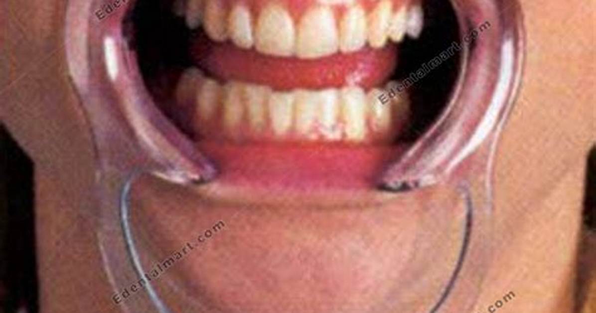 Do Cheek Retractors Hurt?