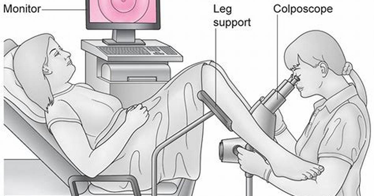 Do Colposcopy Test for Stds?