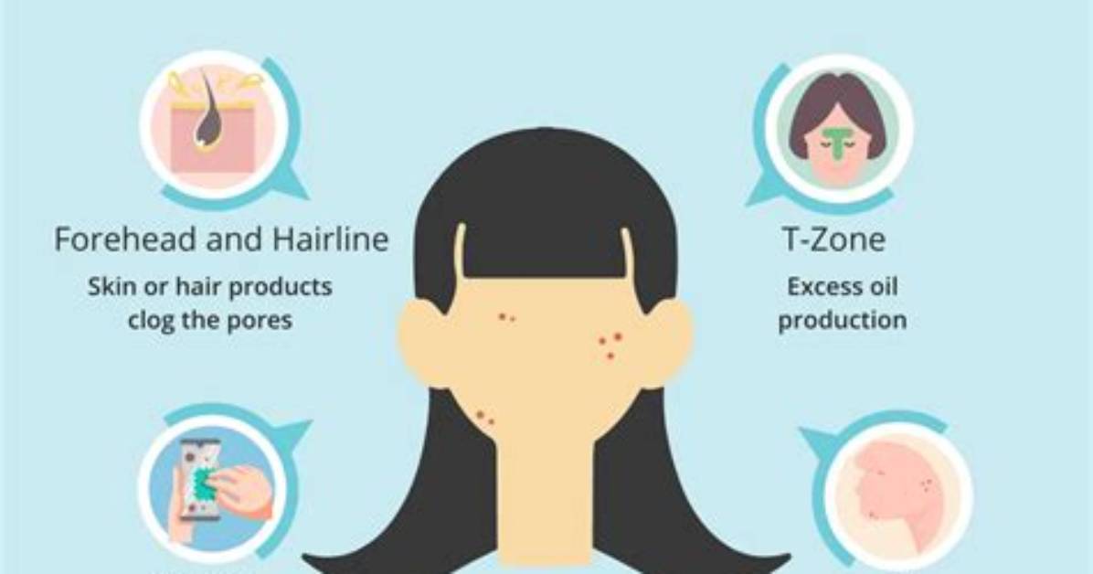 Do Concealer Cause Breakouts?