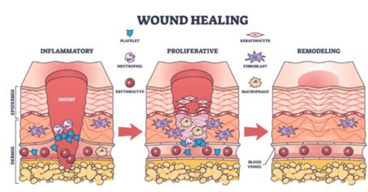 Do Corticosteroids Delay Wound Healing?