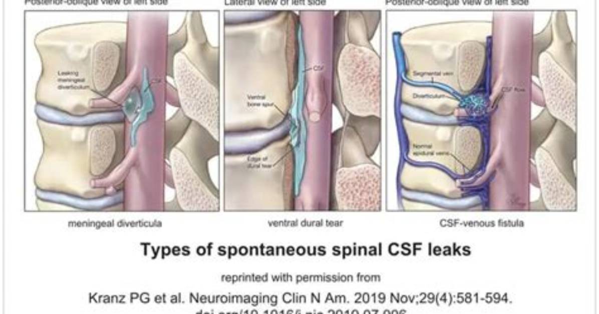 Do Csf Leaks Heal Themselves?