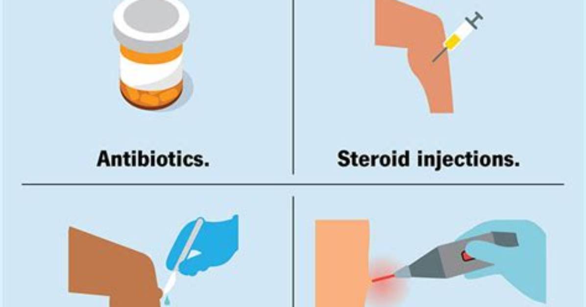 Do Cysts Need to Be Removed?