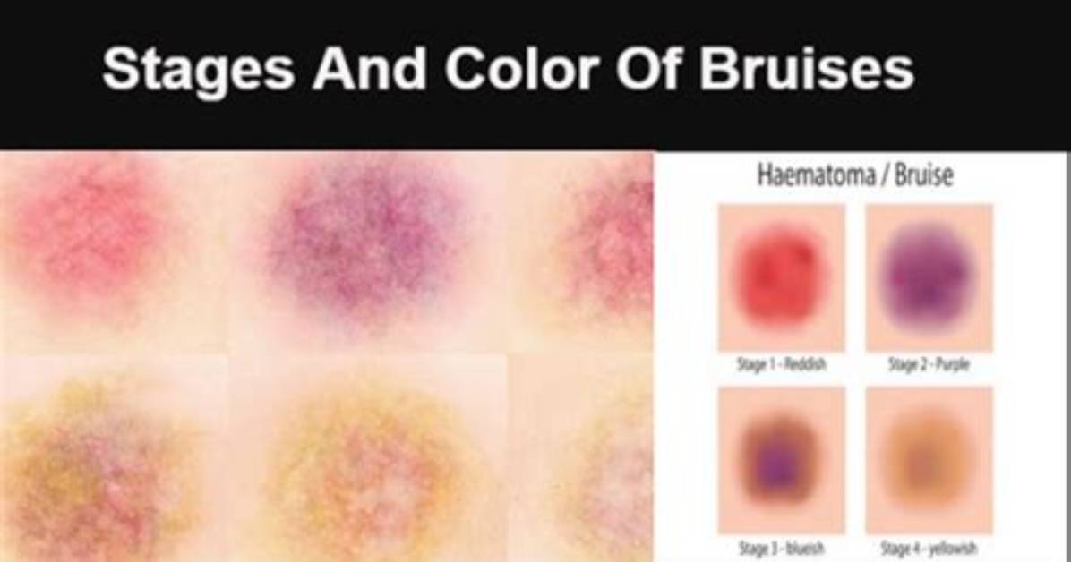 Do Deep Bruises Take Longer to Show?