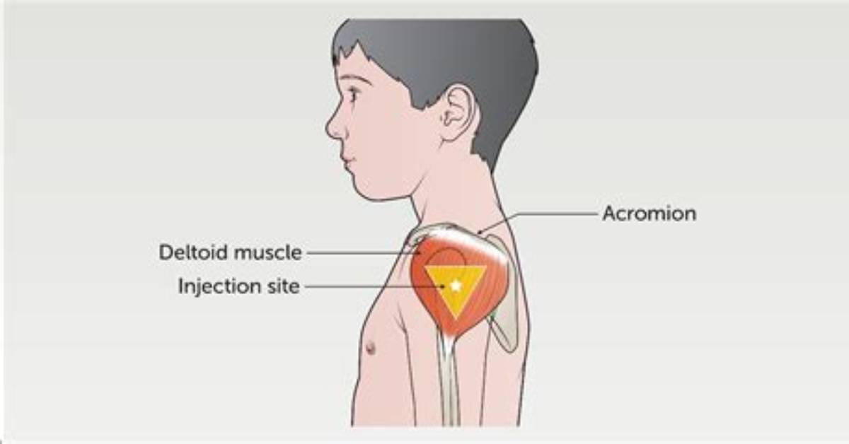 Do Deltoid Injections Hurt?