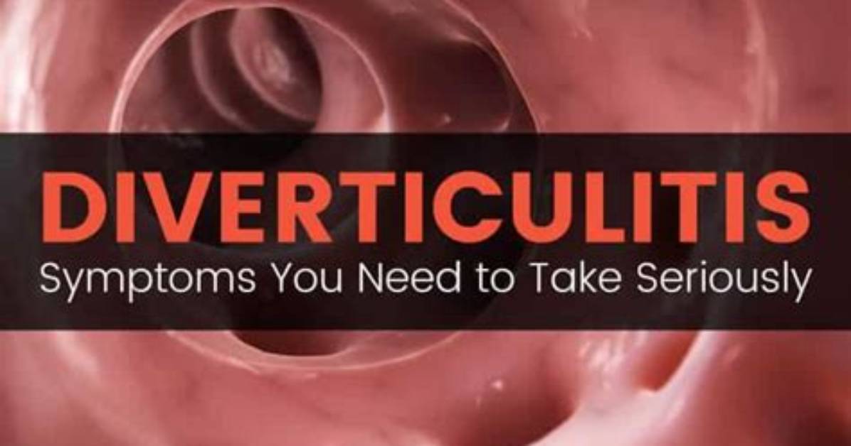 Do Diverticulitis Go Away?