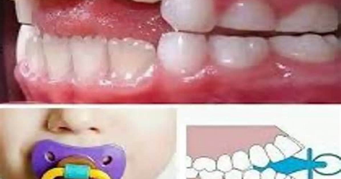 Do Dummies Affect Teeth?
