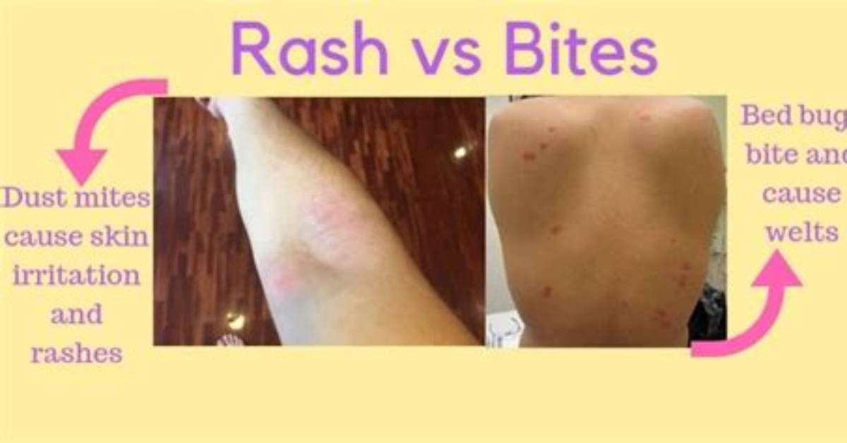 Do Dust Mites Bite?