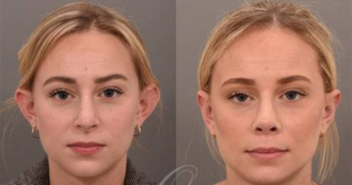 Do Ears Spring Back After Otoplasty?