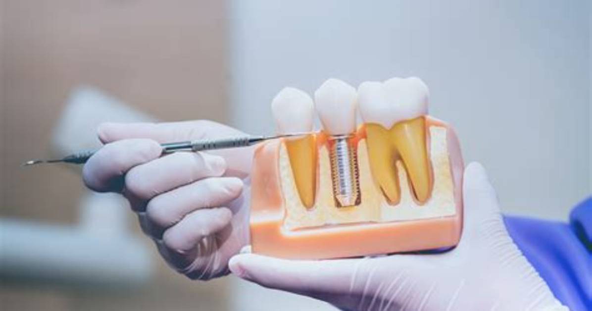 Do Endodontist Do Implants?