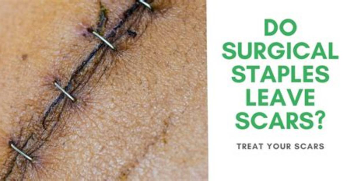 Do Extractions Leave Scars?