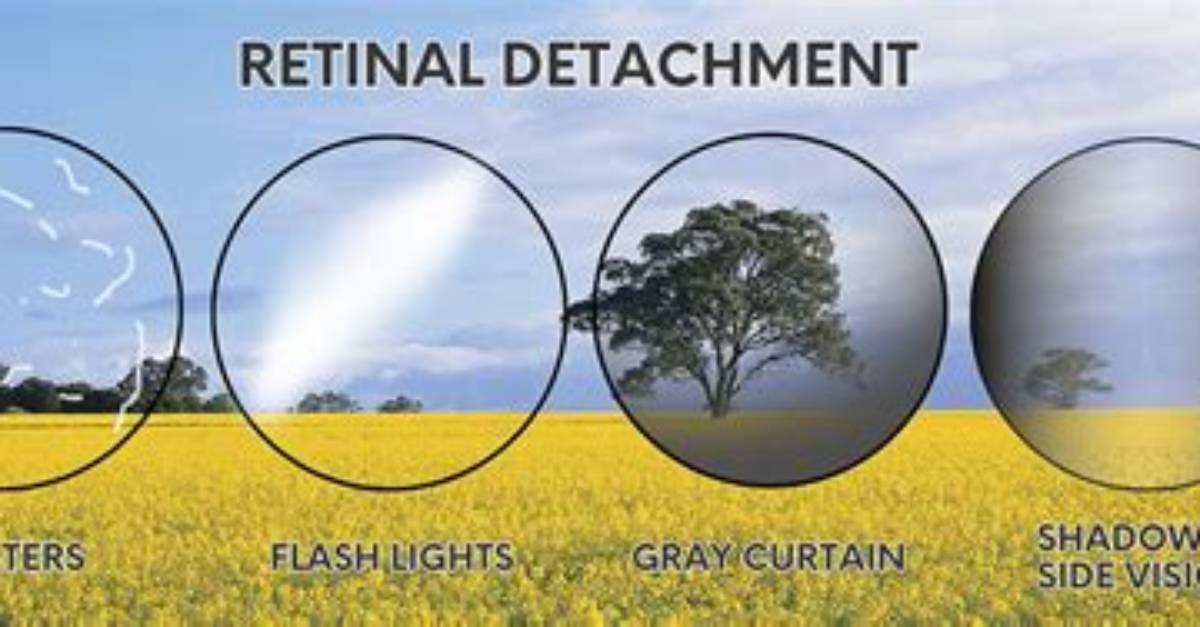 Do Floaters Mean Retinal Detachment?