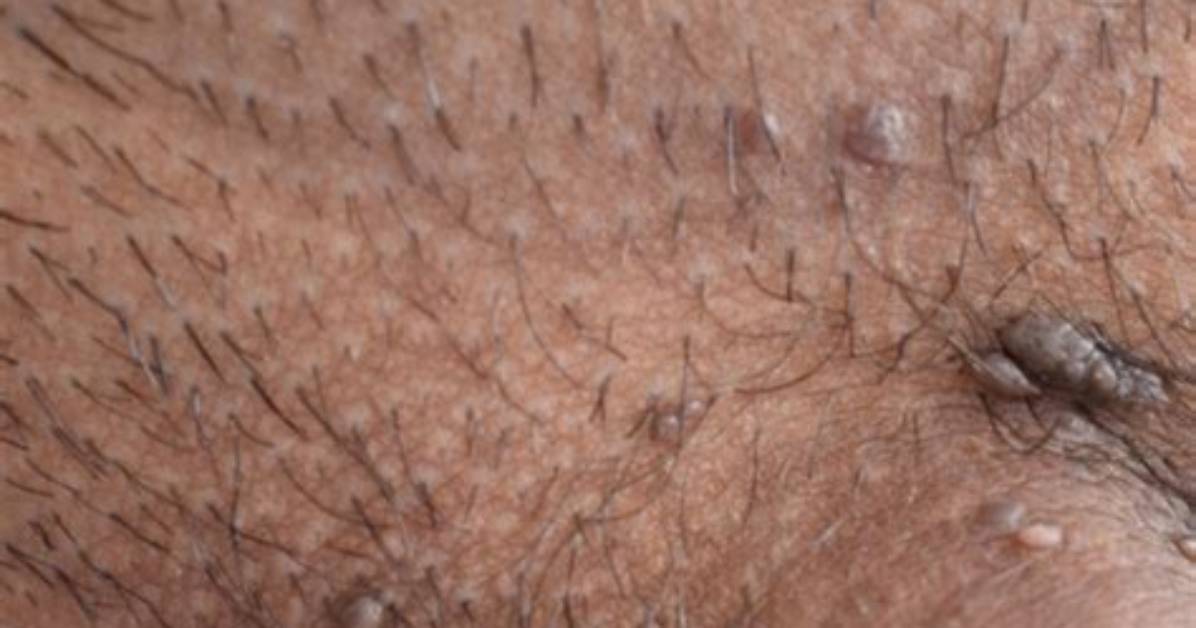 Do Genital Warts Tingle?