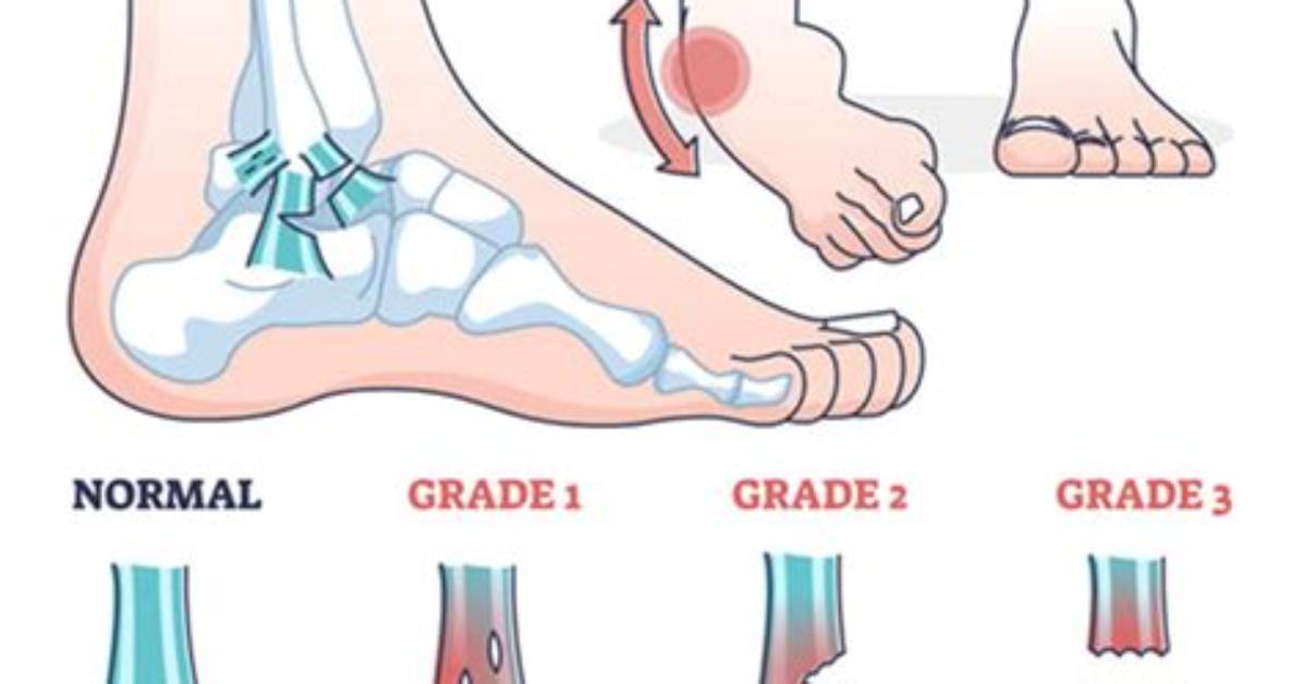 Do Grade 1 Sprains Swell?