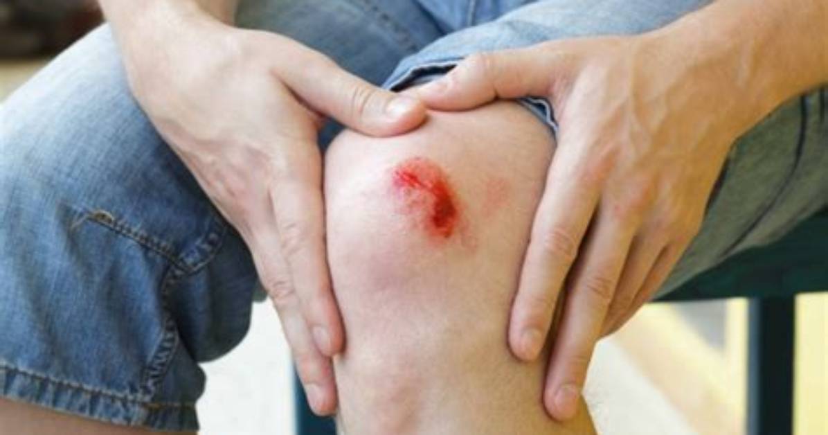 Do Grazed Knees Scar?