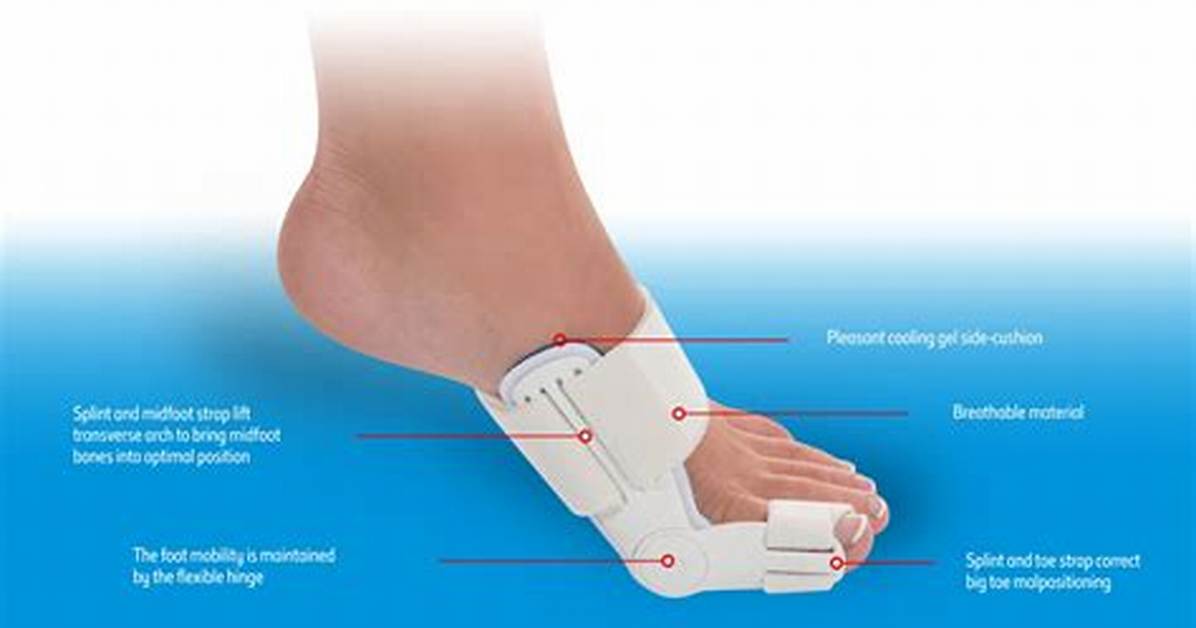 Do Hallux Valgus Splints Work?