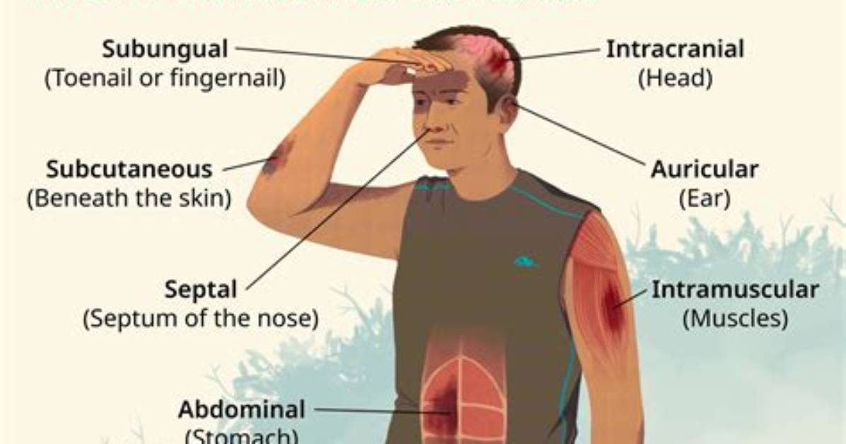 Do Hematomas Need to Be Drained?