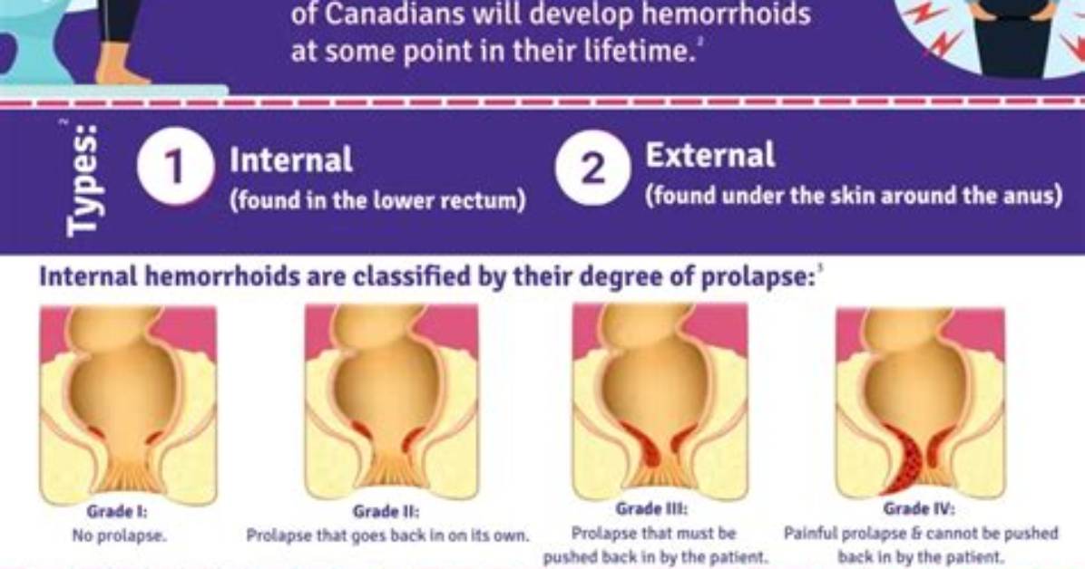Do Hemorrhoids Ever Go Away?