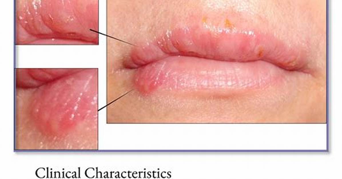 Do Herpes Always Ulcerate?