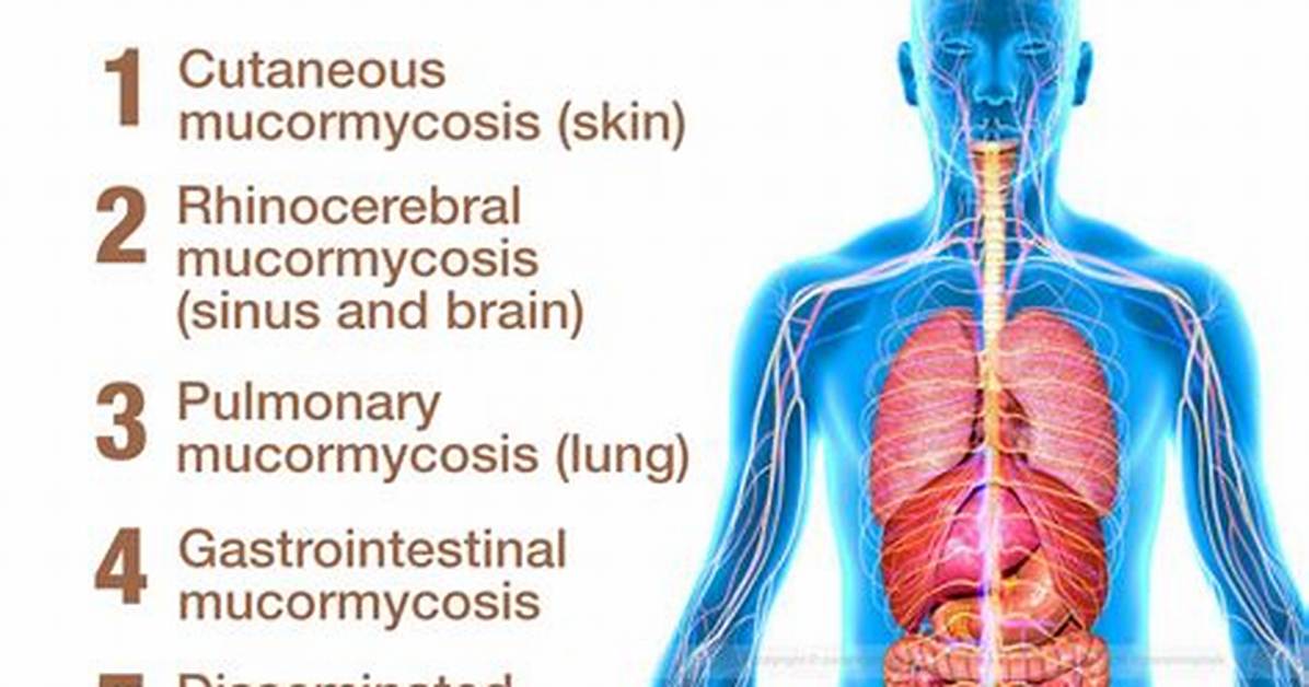 Do I Have Mucormycosis?