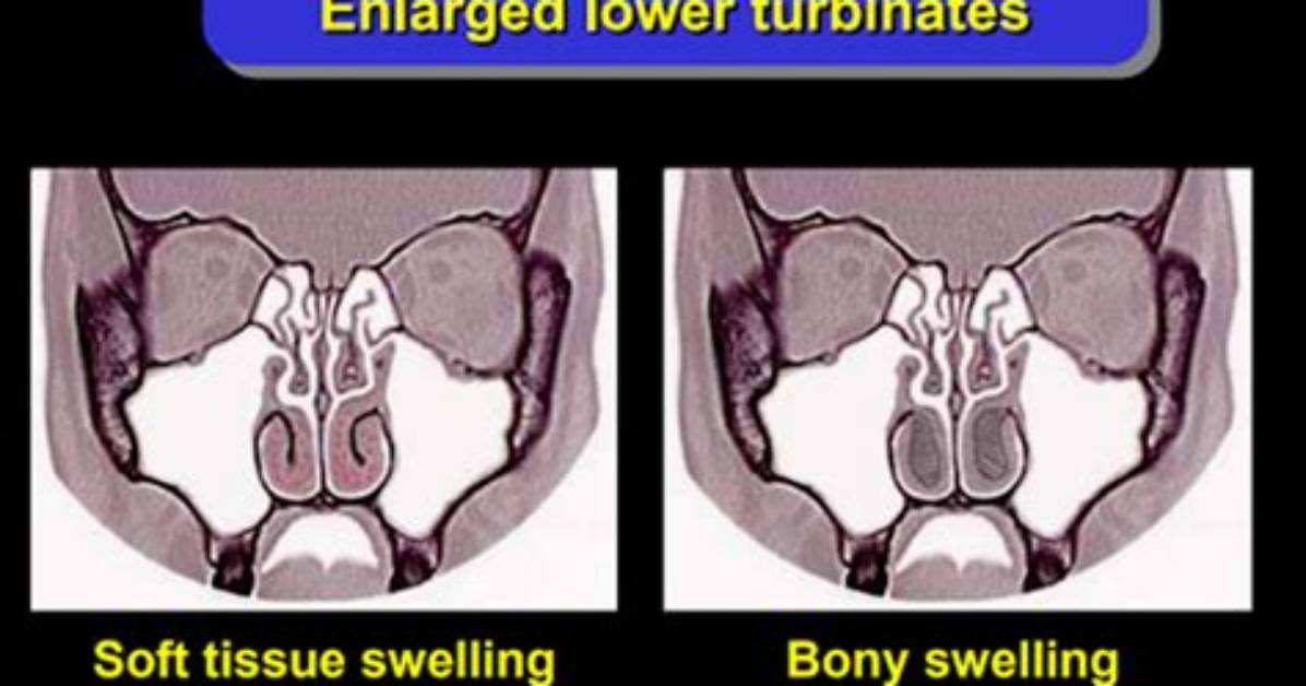 Do I Need a Turbinectomy?