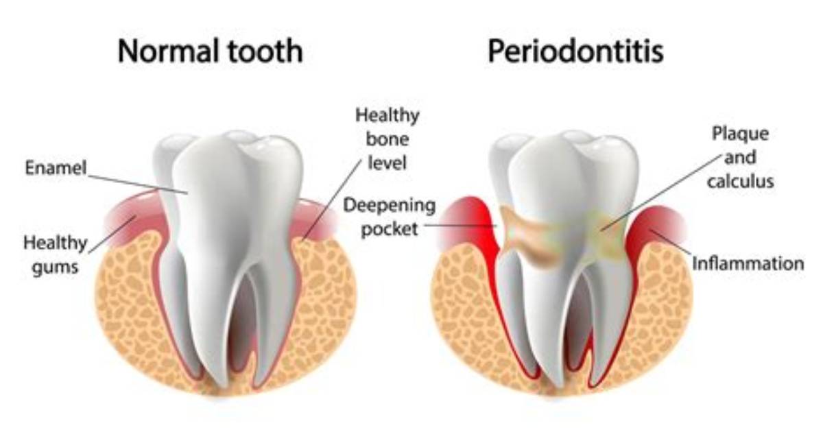 Do I Need Periodontal Maintenance Forever?